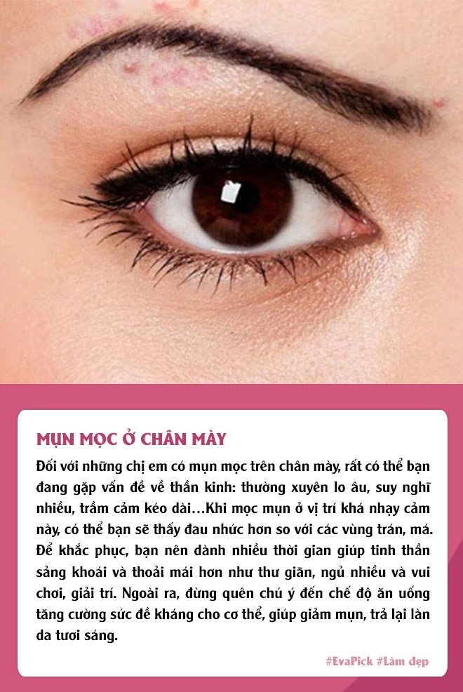 6 vị trí mụn mọc thường gặp trên gương mặt nói gì về tình trạng cơ thể bạn - 2
