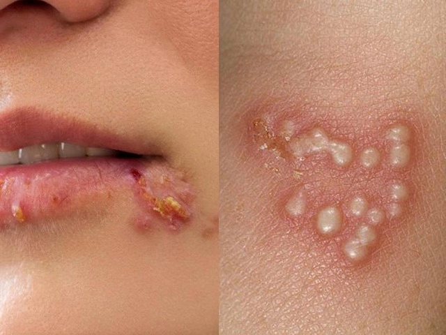 Các loại mụn không nên tự nặn và tuyệt đối không được nặn kẻo nguy hiểm tính mạng - 2