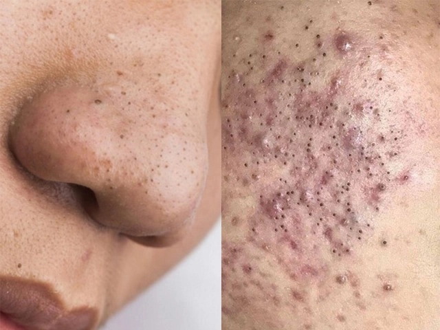 Các loại mụn không nên tự nặn và tuyệt đối không được nặn kẻo nguy hiểm tính mạng - 3
