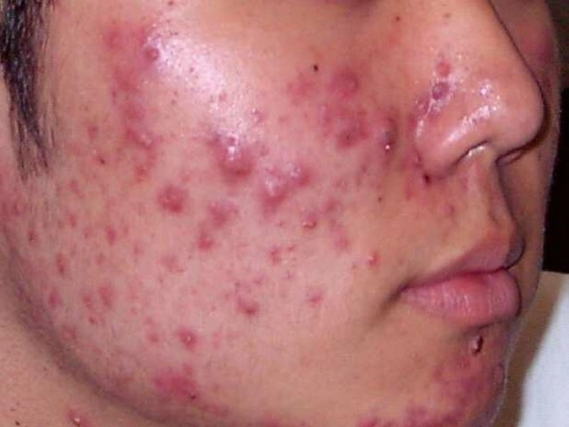 Các loại mụn không nên tự nặn và tuyệt đối không được nặn kẻo nguy hiểm tính mạng - 4