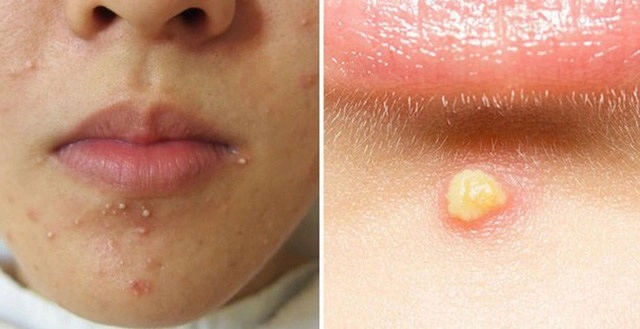 Các loại mụn không nên tự nặn và tuyệt đối không được nặn kẻo nguy hiểm tính mạng - 5