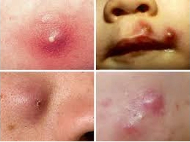 Các loại mụn không nên tự nặn và tuyệt đối không được nặn kẻo nguy hiểm tính mạng - 6