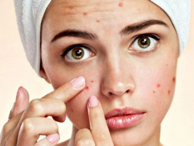 Cách chăm sóc da dầu mụn tại nhà hàng ngày giúp da luôn trắng sáng - 9