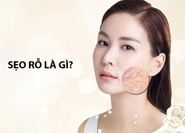 Cách trị sẹo rỗ trên mặt lâu năm tại nhà hiệu quả nhanh nhất - 1