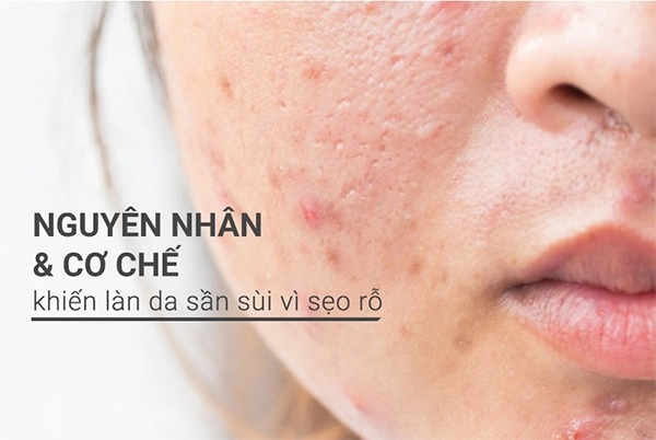 Cách trị sẹo rỗ trên mặt lâu năm tại nhà hiệu quả nhanh nhất - 2