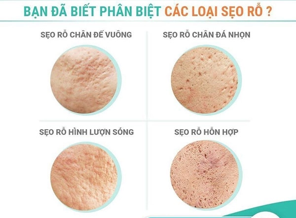Cách trị sẹo rỗ trên mặt lâu năm tại nhà hiệu quả nhanh nhất - 3