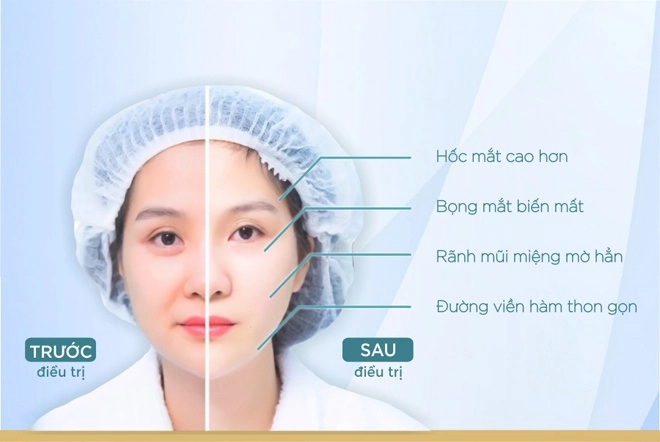 Căng da mặt bằng chỉ và những điều cần biết trước khi chị em quyết định chi tiền - 1