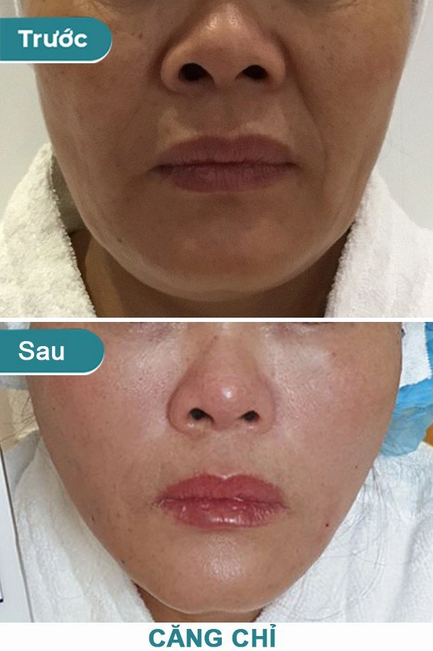 Căng da mặt bằng chỉ và những điều cần biết trước khi chị em quyết định chi tiền - 4