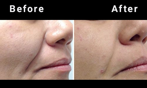 Trẻ hoá da đa tầng với công nghệ laser fotona 4d - 2