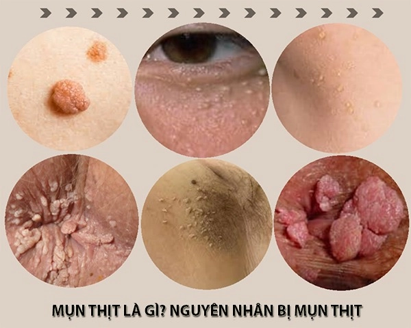 10 cách trị mụn thịt tận gốc tại nhà hiệu quả nhất hiện nay - 1