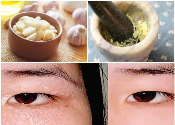 10 cách trị mụn thịt tận gốc tại nhà hiệu quả nhất hiện nay - 3
