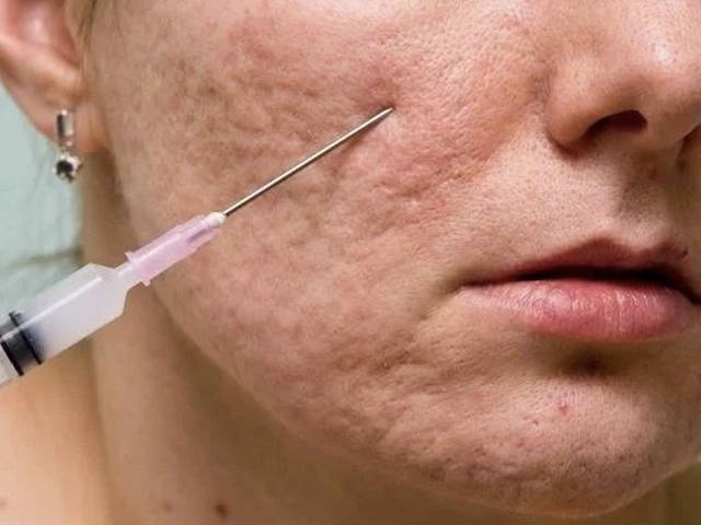 90 sẹo rỗ sẽ được chữa khỏi bằng những phương pháp chữa trị chuyên sâu - 3