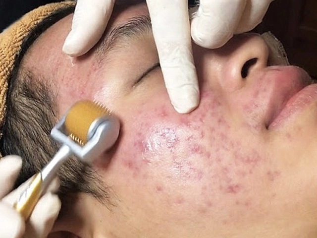 90 sẹo rỗ sẽ được chữa khỏi bằng những phương pháp chữa trị chuyên sâu - 4