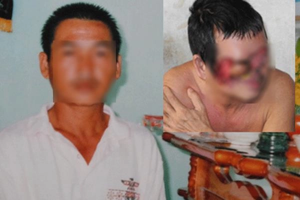 Biến dạng kinh khủng cả khuôn mặt vì tẩy nốt ruồi sai cách chị em nên cảnh giác cao độ - 4