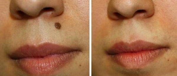 Biến dạng kinh khủng cả khuôn mặt vì tẩy nốt ruồi sai cách chị em nên cảnh giác cao độ - 7