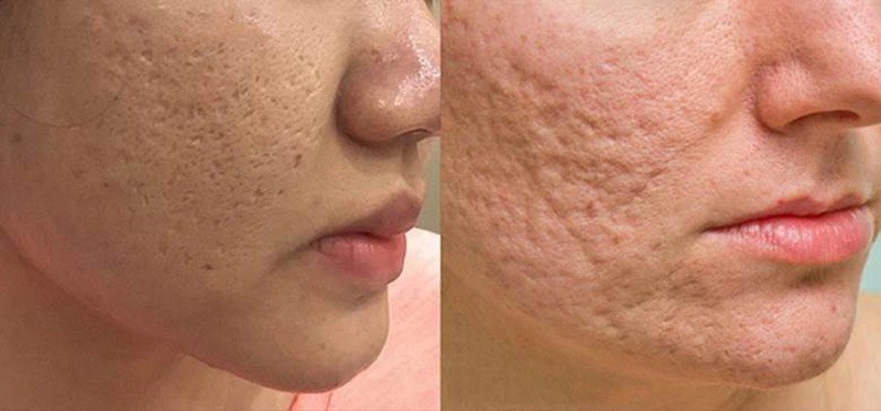 Biết được lí do da mặt sẹo rỗ kém sang bạn sẽ không bao giờ dám nặn mụn nữa - 1