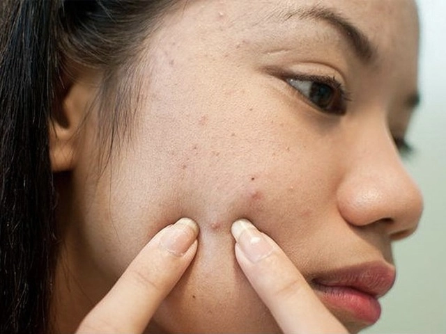 Biết được lí do da mặt sẹo rỗ kém sang bạn sẽ không bao giờ dám nặn mụn nữa - 3