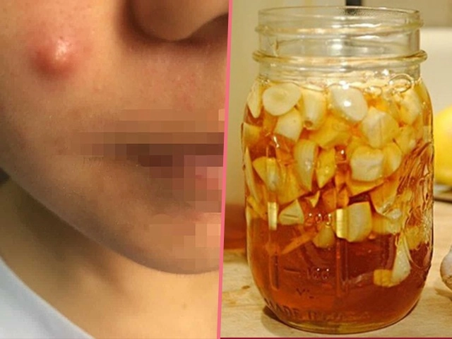 Có 4 cách trị mụn bọc bằng tỏi chà đến đâu mụn xẹp ngay đến đó - 1