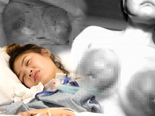 Cứ nắm rõ những điều sau nàng sẽ có quyết định phẫu thuật nâng cấp vòng 1 đúng đắn nhất - 7
