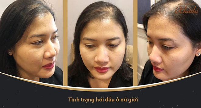 Giải pháp cấp cứu hiệu quả cho mái tóc thưa mỏng của chị em - 1