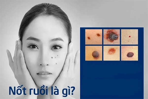 Tẩy nốt ruồi tại nhà và những lưu ý cần biết để tránh hậu quả khôn lường - 1