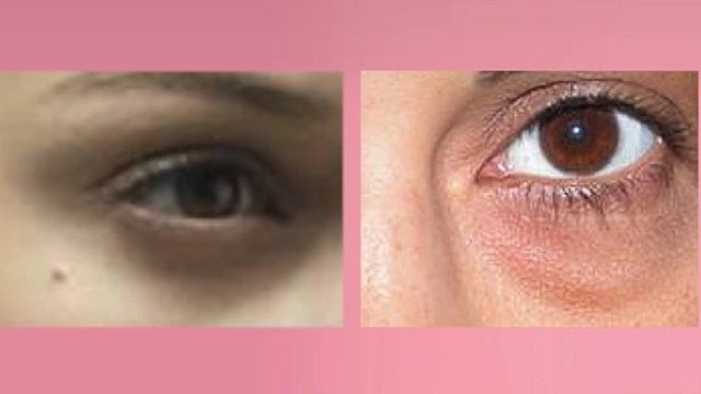Bị quầng thâm mắt bấy lâu nhưng bạn đã biết mình thuộc loại thâm gì chưa - 9