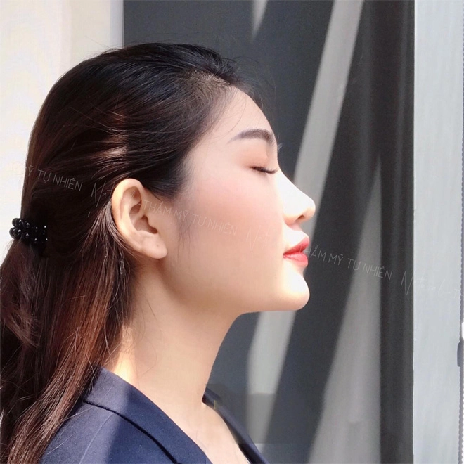 Nâng mũi tại natural sửa một lần đẹp một đời - 1