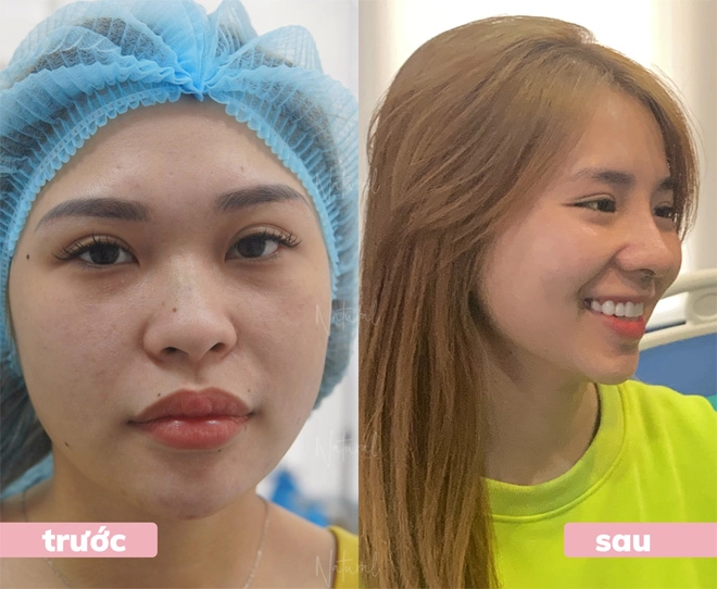 Nâng mũi tại natural sửa một lần đẹp một đời - 2