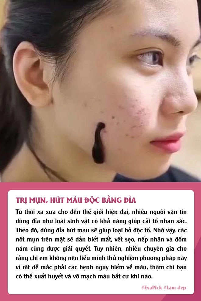 Phương pháp làm đẹp độc lạ vẫn được chị em áp dụng đắp mask phân chim dùng đỉa hút mụn - 4