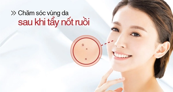 Tẩy nốt ruồi tại nhà và những lưu ý cần biết để tránh hậu quả khôn lường - 10