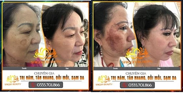 Trị nám tàn nhang uy tín tại tmv saigon beauty - 4
