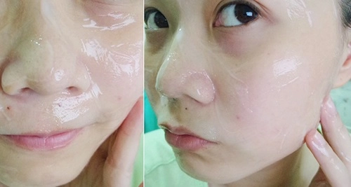 5 cách trị mụn ẩn trên trán tại nhà giúp nhân tự khắc trồi lên mà không cần nặn - 5