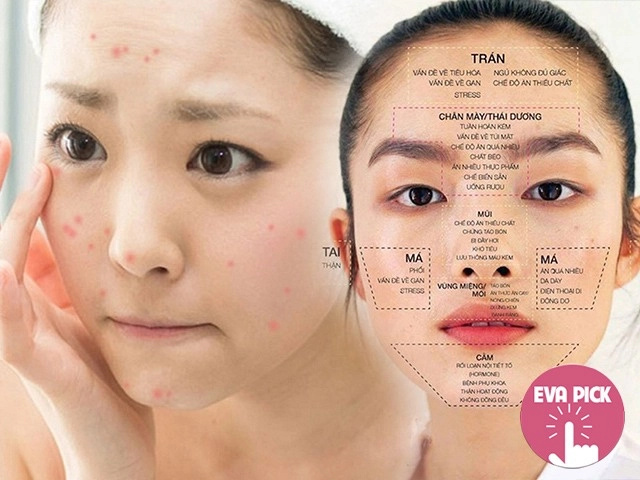5 cách trị mụn ẩn trên trán tại nhà giúp nhân tự khắc trồi lên mà không cần nặn - 9