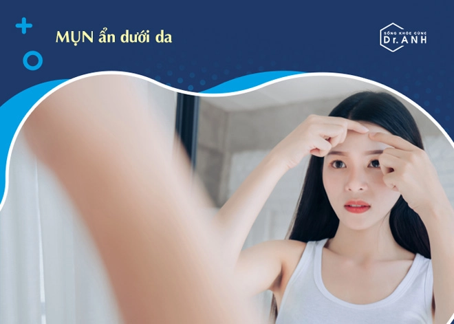 Bối rối vì mụn ẩn học ngay cách xử lý hiệu quả từ chuyên gia biodermato - 1