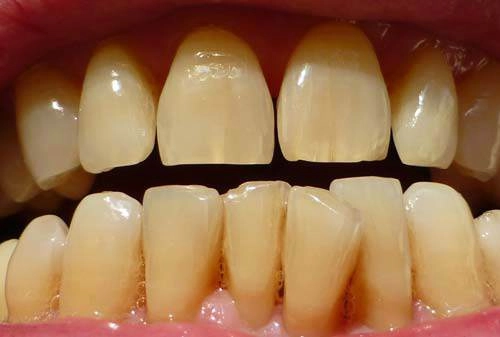 Hết sạch cao răng mảng bám ố vàng nếu bạn chà đều đặn thứ này mỗi tối - 1
