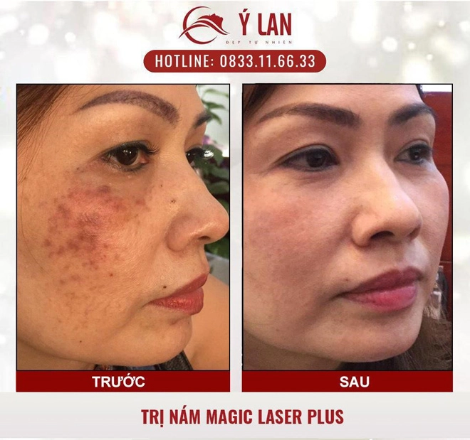 Hy vọng mới cho người bị nám da tàn nhang - 1