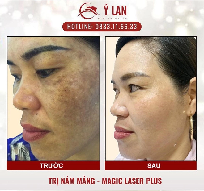 Hy vọng mới cho người bị nám da tàn nhang - 2