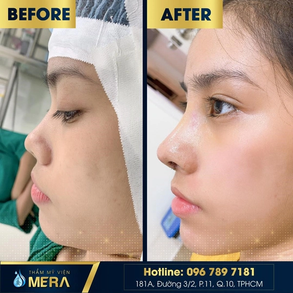 Nâng mũi an toàn với phương pháp cấu trúc tại tmv mera - 1