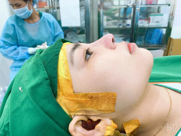 Nâng mũi an toàn với phương pháp cấu trúc tại tmv mera - 4