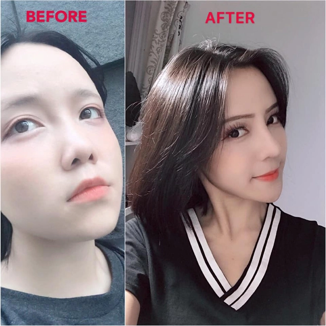 Phẫu thuật nâng mũi ảnh hưởng đến cả tài vận chuyên gia thẩm mỹ nói gì - 1