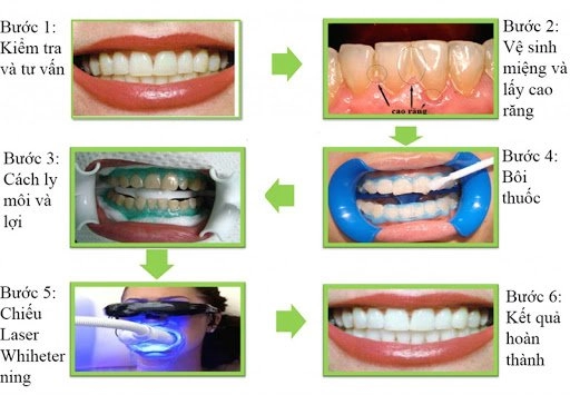 Tẩy trắng răng và những lưu ý cần biết về làm trắng răng tại nhà - 3