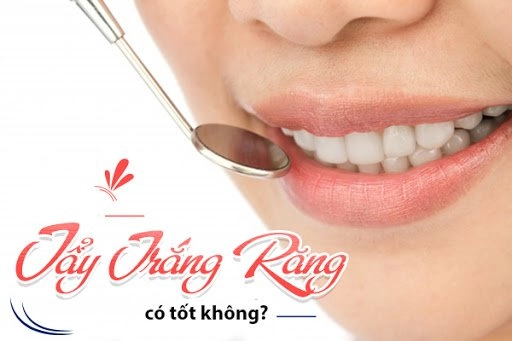 Tẩy trắng răng và những lưu ý cần biết về làm trắng răng tại nhà - 4