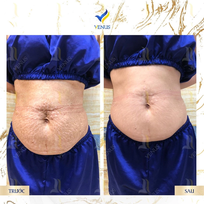 Xóa tan mặc cảm rạn da với công nghệ laser ultrapulse plus không xâm lấn - 4