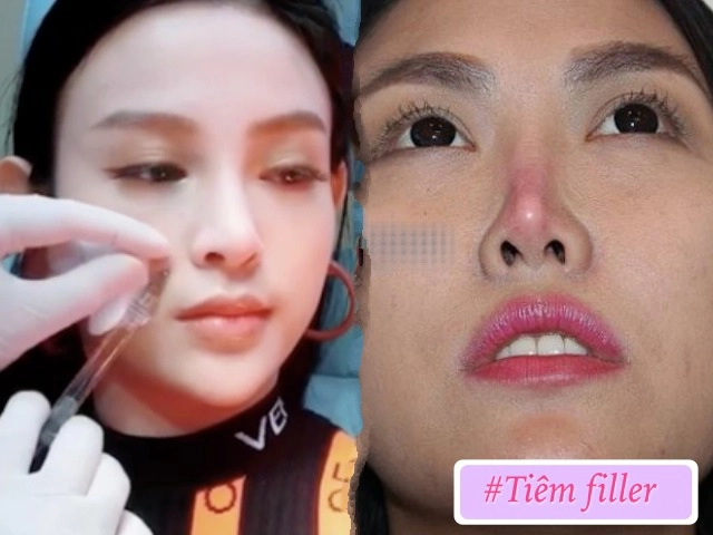 Mắc phải những sai lầm tai hại này khi tiêm filler chị em có thể phá huỷ cả gương mặt - 12