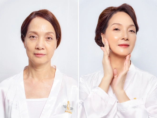 Nsnd lê khanh hơn 50 năm tôi mới đủ can đảm đến thẩm mỹ viện làm đẹp - 2