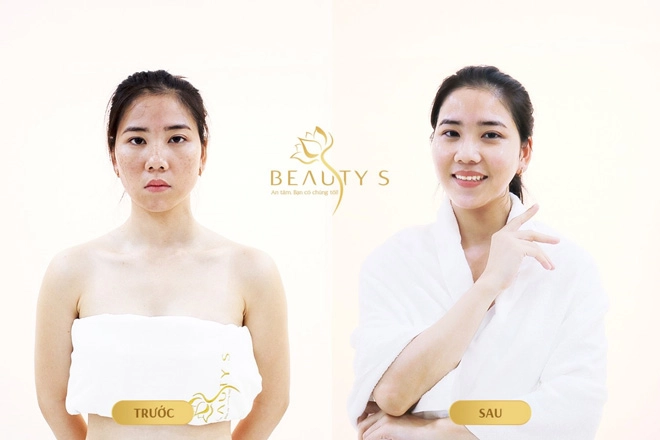 Sạch tàn nhang chỉ 1 lần duy nhất bằng công nghệ bes melas - 3