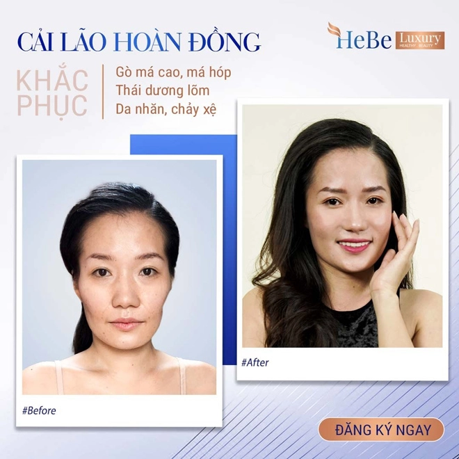 Bật mí về công nghệ cải lão hoàn đồng khắc phục má hóp gò má cao - 2