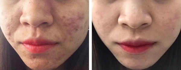 Hành trình xoá mụn phục hồi của những làn da tưởng chừng không thể cứu vãn - 1