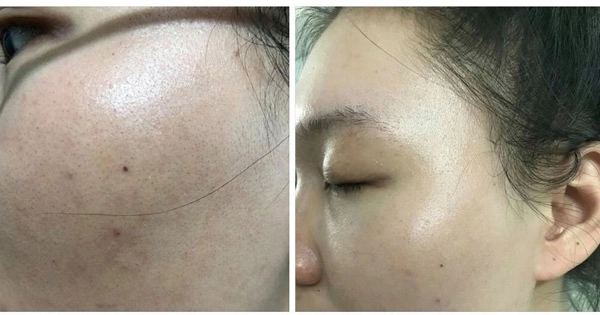 Hành trình xoá mụn phục hồi của những làn da tưởng chừng không thể cứu vãn - 3