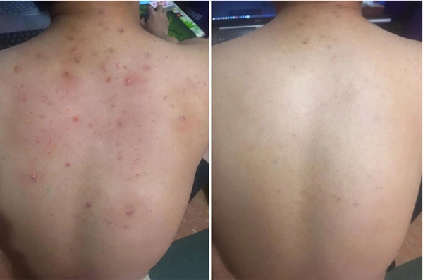 Hành trình xoá mụn phục hồi của những làn da tưởng chừng không thể cứu vãn - 4